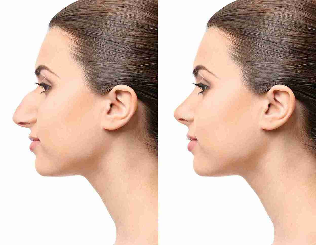 Rhinoplasty Surgery Mumbai