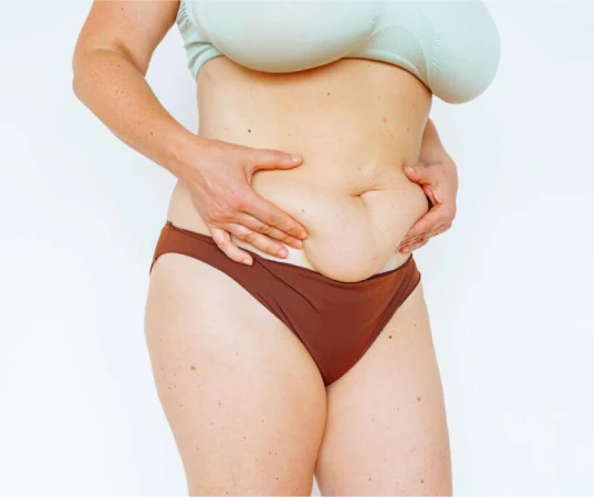 Abdominoplasty