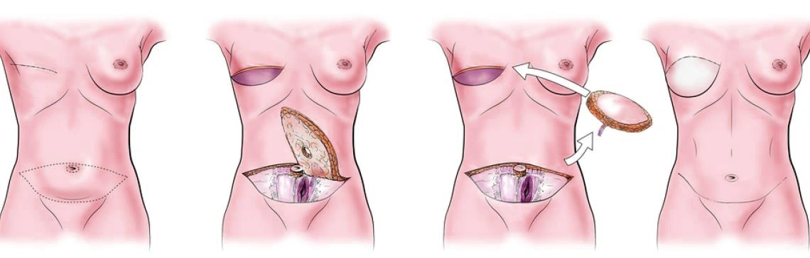 Breast Reconstruction Post Cancer Producer