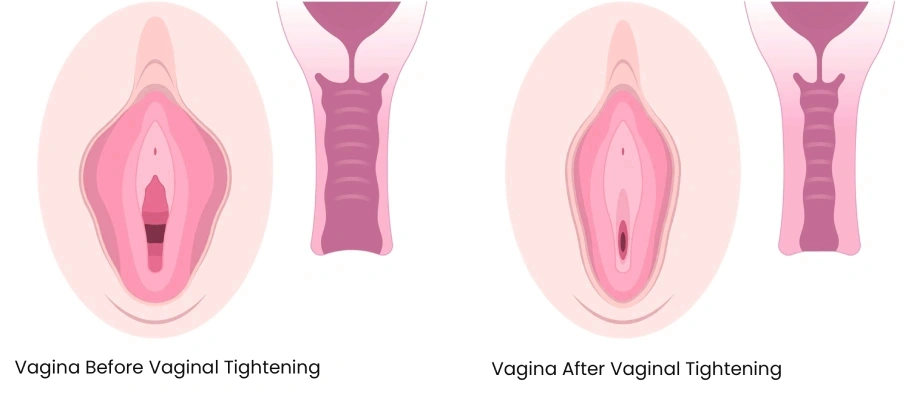 Vaginal Tightening Before after result