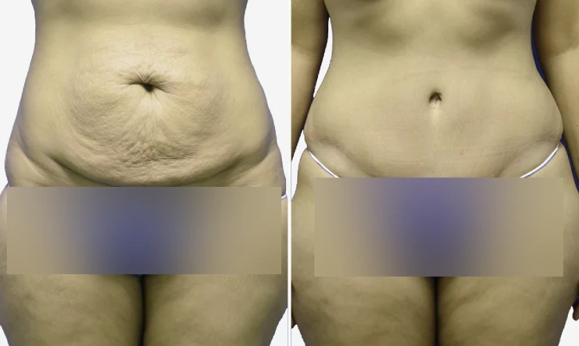 Abdominoplasty