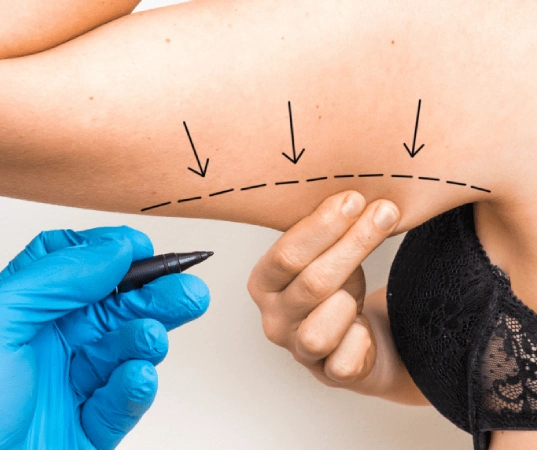 Arm lift surgery