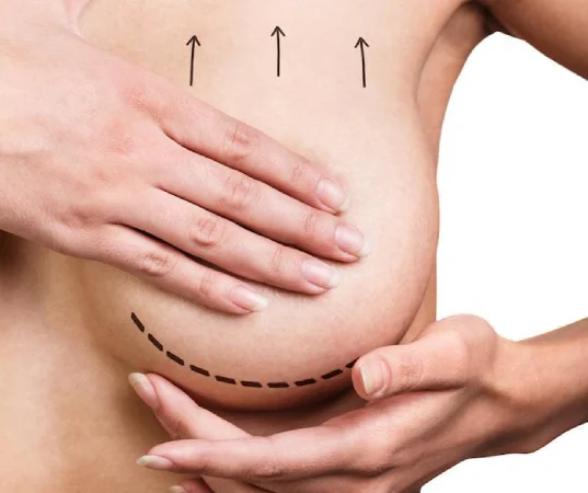breast lift