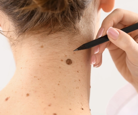 skin cancer