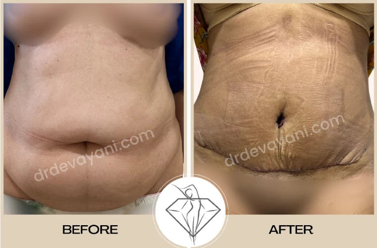 Abdominoplasty Abdominoplasty