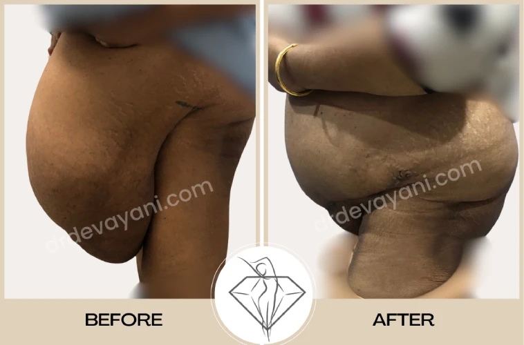 Abdominoplasty Abdominoplasty