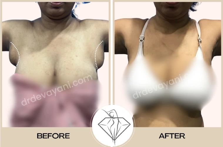 Axillary Breast