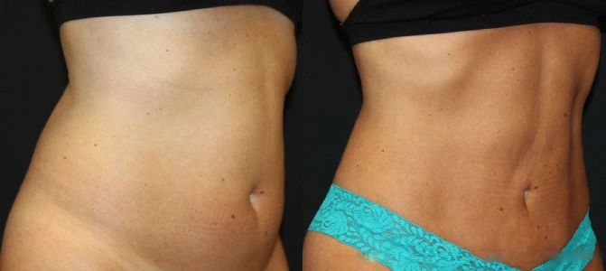 BodyTite Before After