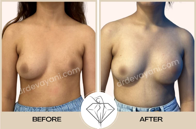 Breast Asymmetry