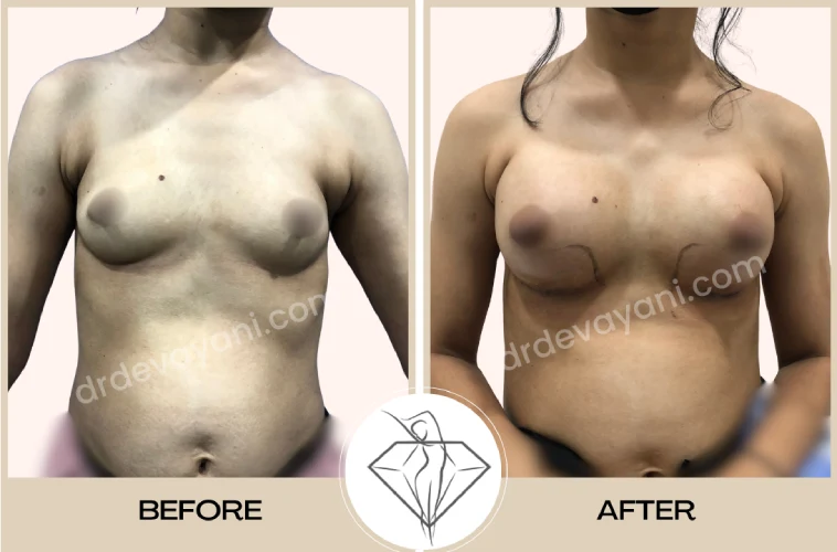 Breast Implant