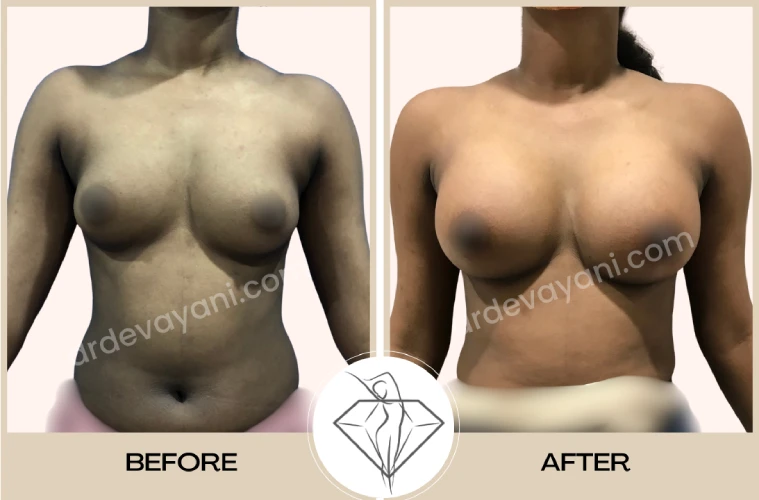 Breast Implant