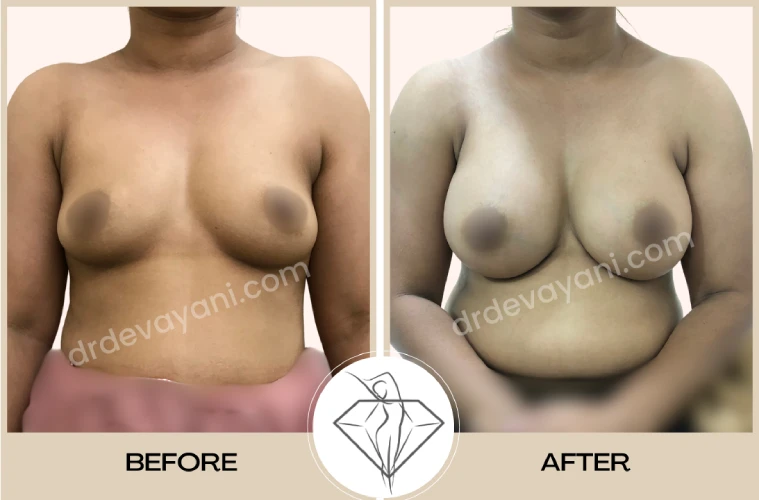 Breast-Implant