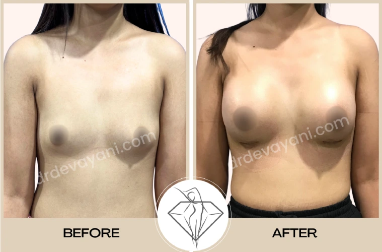 Breast Implant
