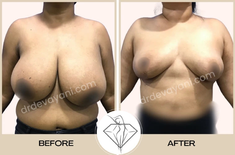 Breast reduction