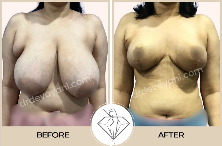 Breast-reduction