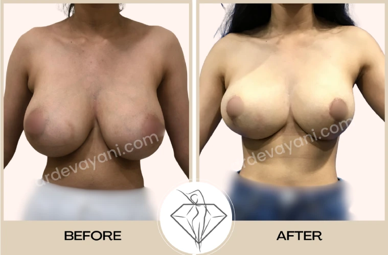 Breast Reduction