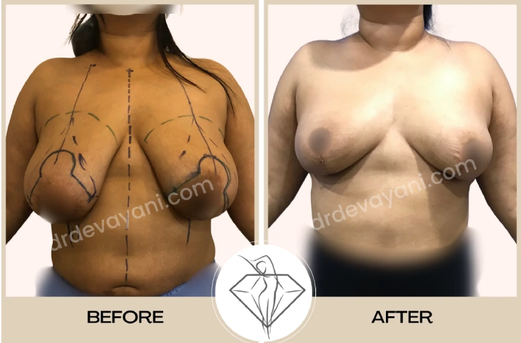 Breast Reduction