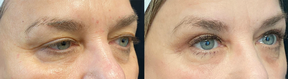 accutite before and after