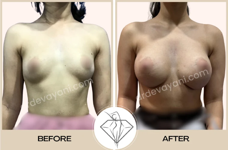 Breast Implant