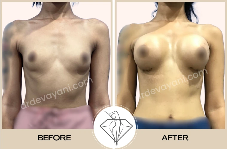 Breast Implant