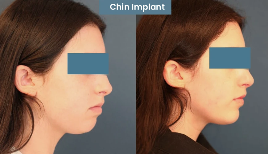 Chine Implant