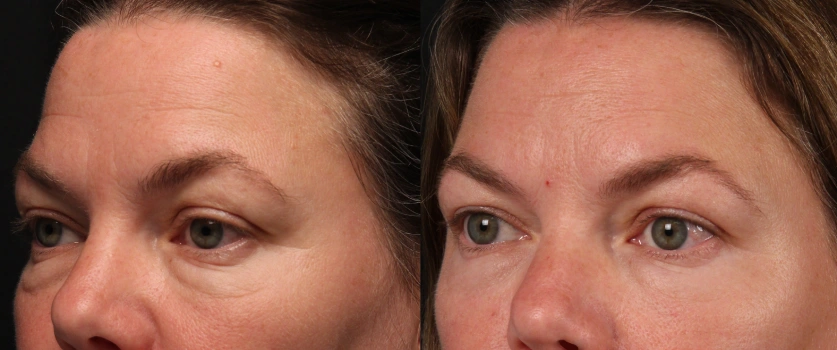 Facetite and morpheus8 before after result