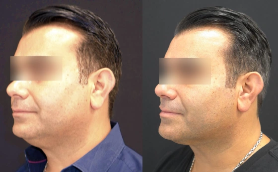 Facetite Before After Result