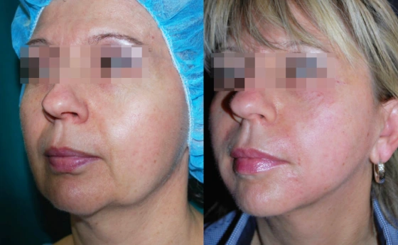 Facetite Before After Result