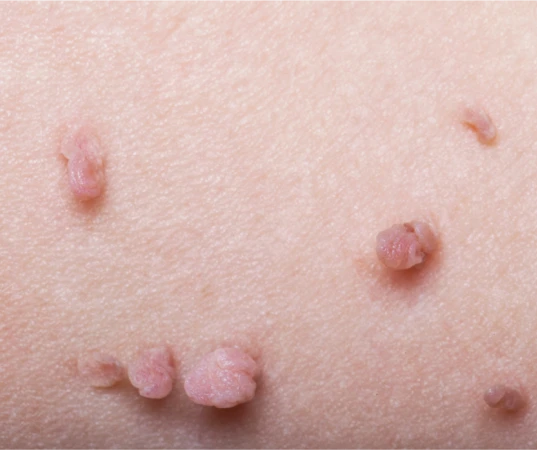 skin tag removal