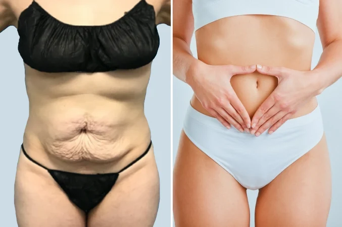 tummy tuck surgery in mumbai tummy tuck surgery in mumbai